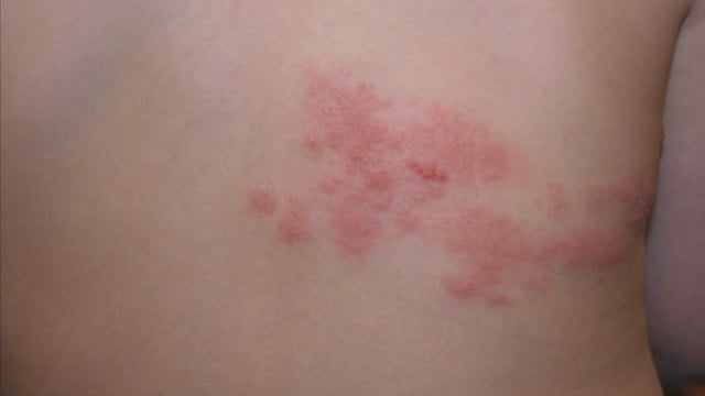 Sentara Martha Jefferson Monday: What is Shingles?