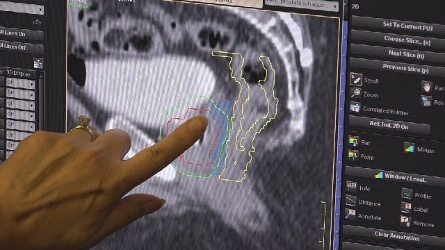 Sentara Martha Jefferson Monday: Limiting Radiation Exposure When Treating Prostate Cancer