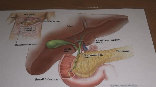 Sentara Martha Jefferson Monday: Gall Stones and Gall Bladder Surgery