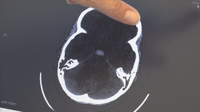 Sentara Martha Jefferson Monday: Radial Access Technique for Treating Strokes