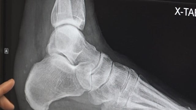 Sentara Martha Jefferson Monday: Foot and Ankle Injuries and Surgery