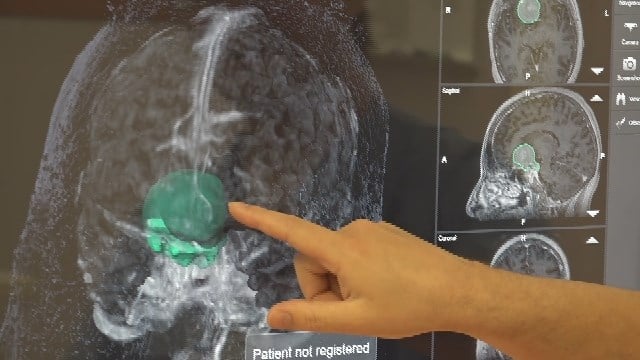 Sentara Martha Jefferson Monday: Improved Technology Helps Doctors Treat Brain Tumors